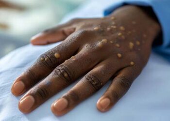 le mpox